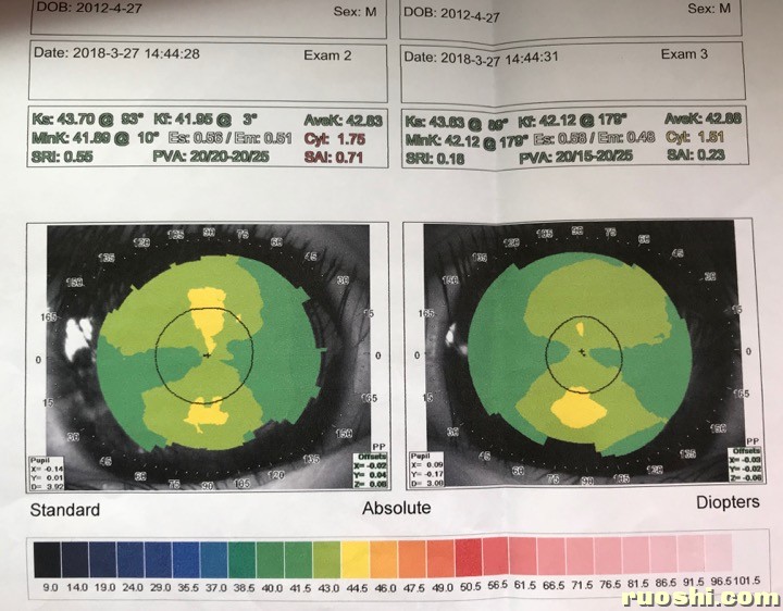 2018-3-27角膜地形图.JPG