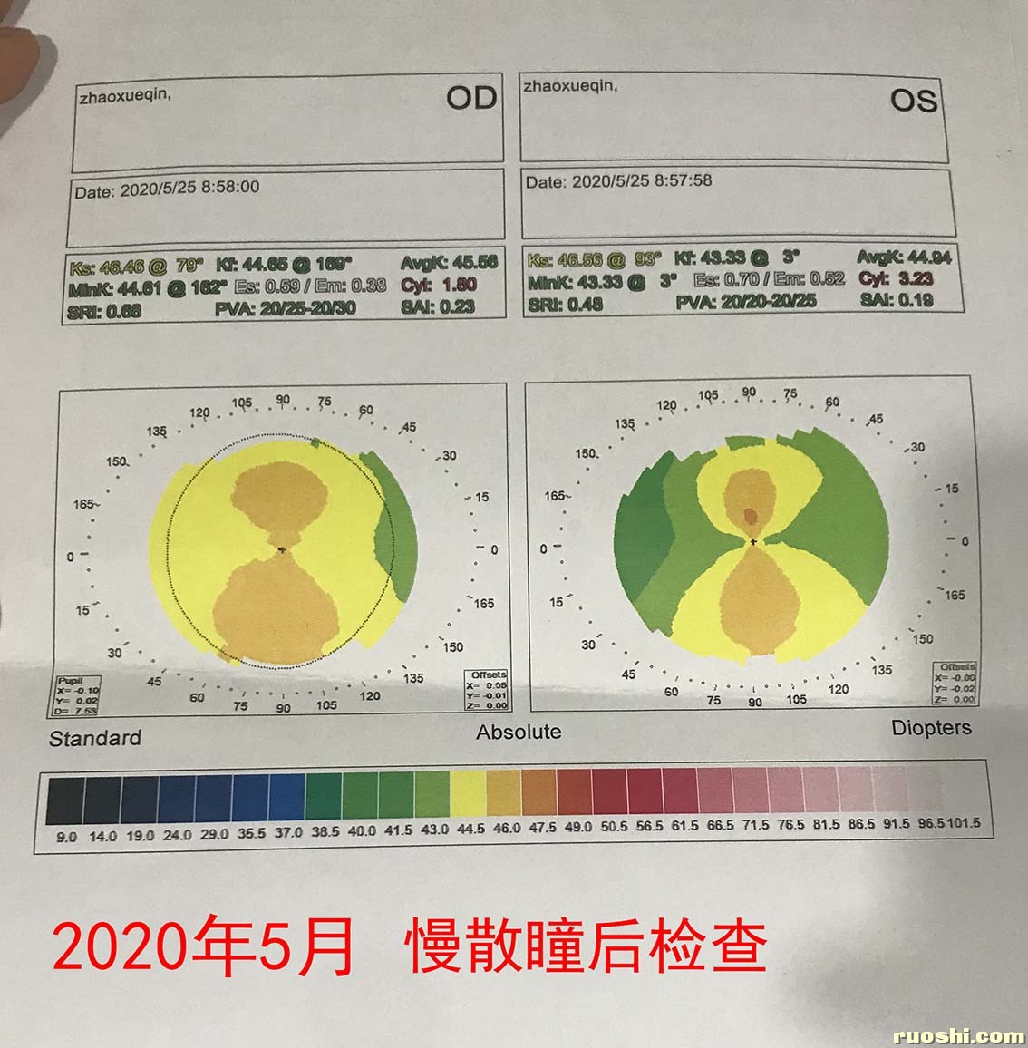 20年角膜地形图.jpg