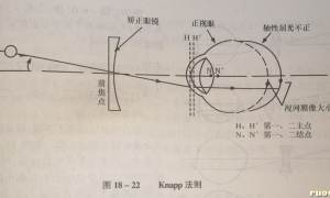 近视性屈光参差戴镜后不产生不等像？