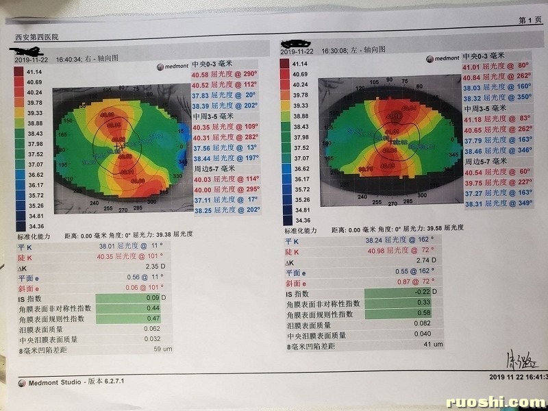 17-2019年11月22号角膜地形图（四院）