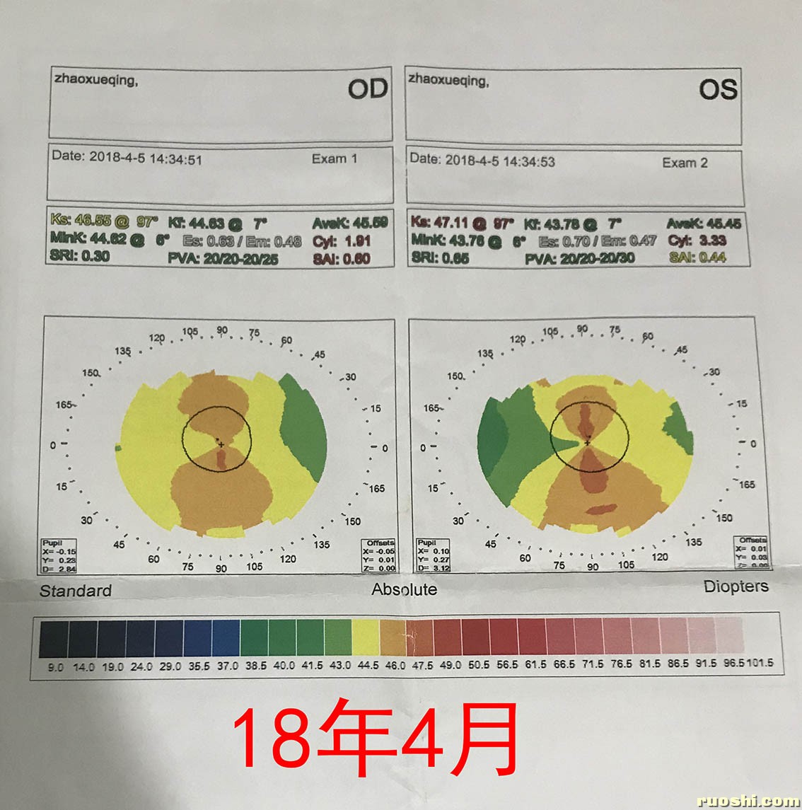 18年角膜地形图.jpg