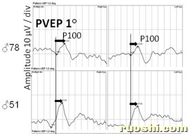 PVEP波形